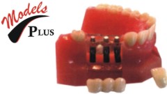 Implant Windowed Crown & Bridge